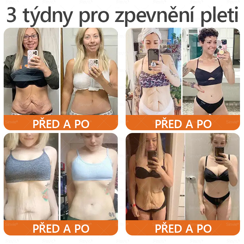 🐝 Sinvie® Krém na obnovu pleti s včelím jedem(👨⚕CE schváleno)👍✅