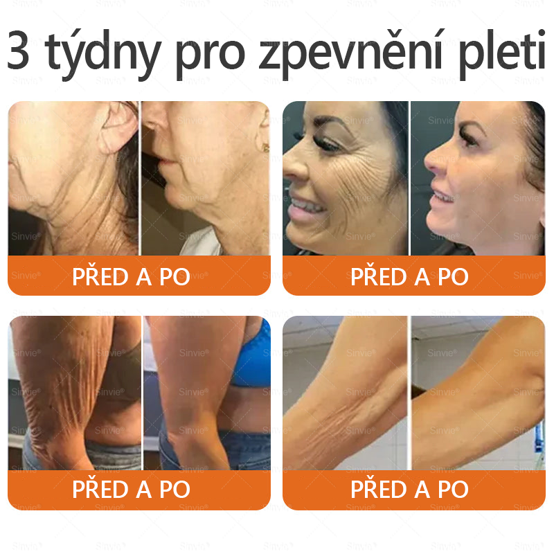 🐝 Sinvie® Krém na obnovu pleti s včelím jedem(👨⚕CE schváleno)👍✅
