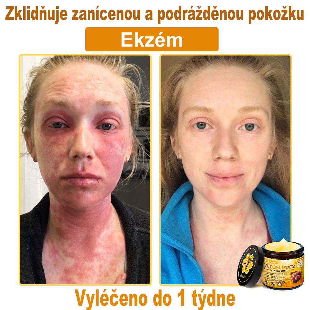 🐝 Sinvie® Krém na obnovu pleti s včelím jedem(👨⚕CE schváleno)👍✅