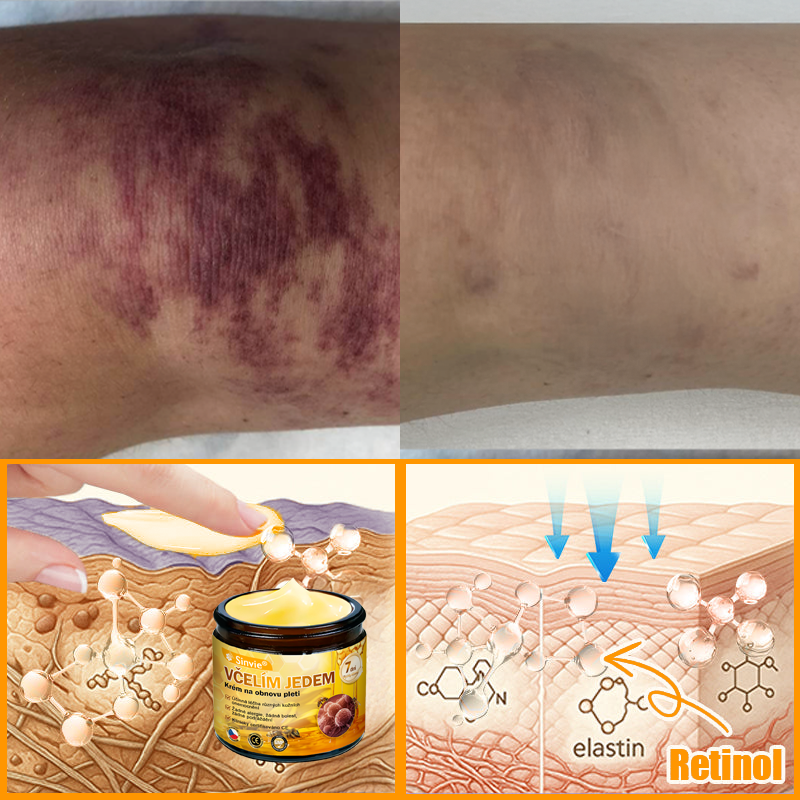 🐝 Sinvie® Krém na obnovu pleti s včelím jedem(👨⚕CE schváleno)👍✅